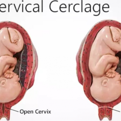 Servikal Serklaj Nedir?